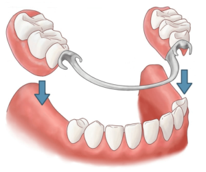 Dental Partials diagram