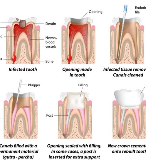 root-canal-treatment-kinddental